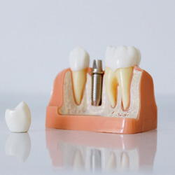 model showing each part of a dental implant