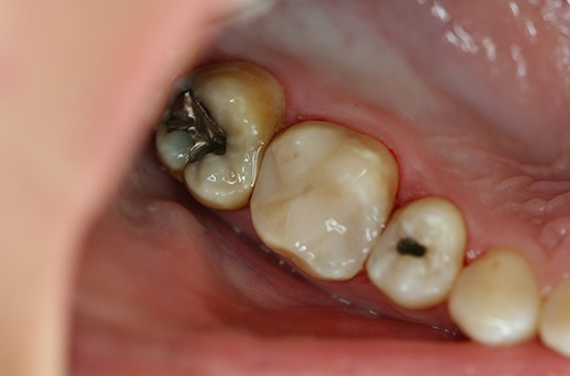 Tooth restored with natural looking dental crown