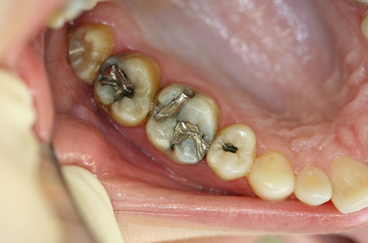 Tooth with several worn metal fillings