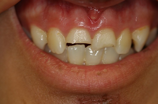 Broken top front tooth