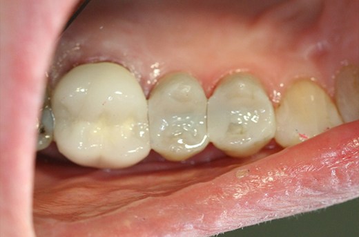 Metal fillings replaced with tooth-colored restorations