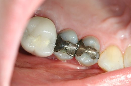 Several teeth with large metal fillings