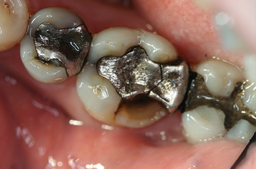 Large metal filling and broken tooth