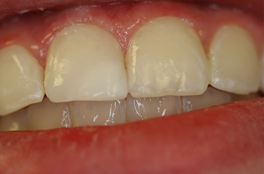 Natural looking restored top front tooth