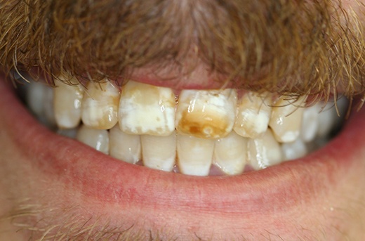 Severely discolored teeth