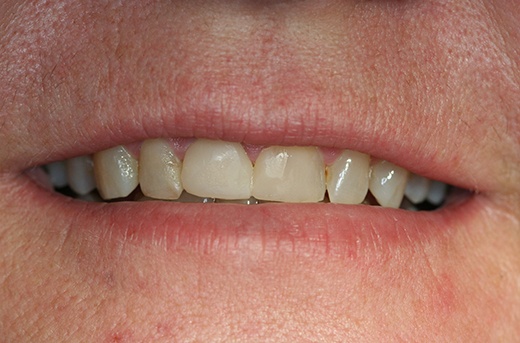Discolored and worn teeth
