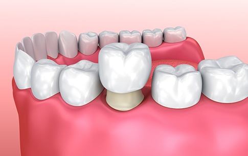 Animation of dental crown placement