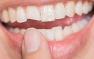 Closeup of smile with chipped tooth