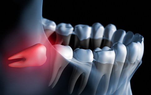 Animation of impacted wisdom tooth