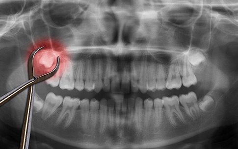 X-ray of impacted wisdom tooth