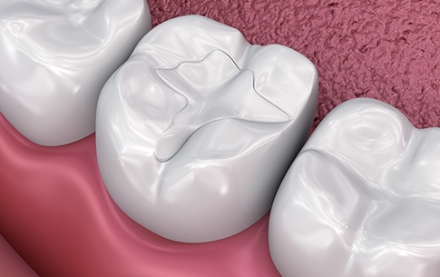 Animation of smile with tooth-colored filling