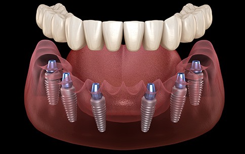 Digital illustration of implant dentures