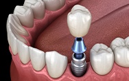 Animation of implant supported dental crown placement