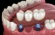 Animation of implant supported fixed bridge placement