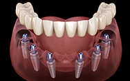 Animation of implant supported denture placement