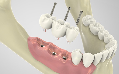 Animation of components of implant supported fixed bridge