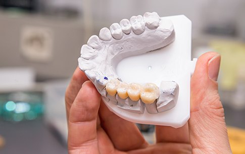 Model smile with implant supported fixed bridge