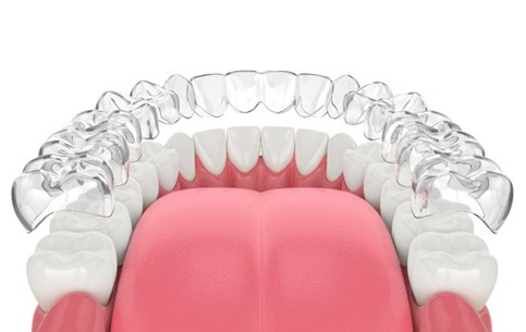 Illustration of clear aligner being placed on lower row of teeth