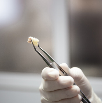 Dentist holding an extracted tooth