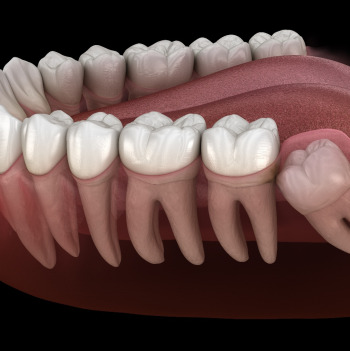 Illustration of an impacted wisdom tooth