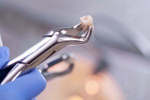 Closeup of forceps grasping extracted tooth