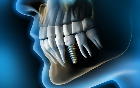 Animation of implant supported dental crown