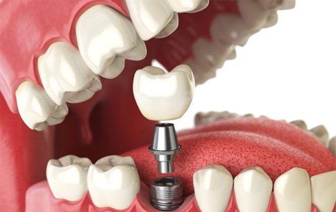 a 3 D illustration of a dental implant and abutment
