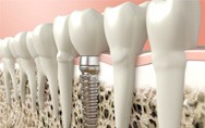 a 3 D illustration of a dental implant undergoing osseointegration