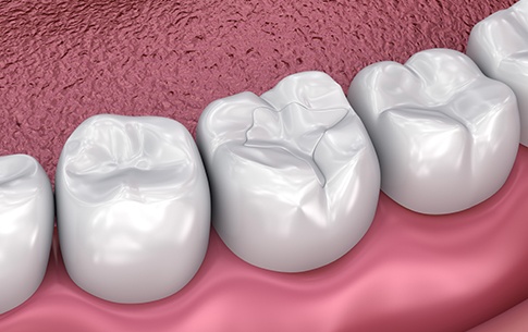 Animation of smile with tooth-colored filling