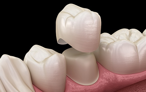 Animation of dental crown placement