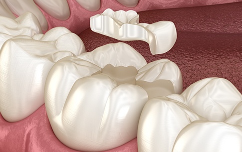 Animation of porcelain inlay placement