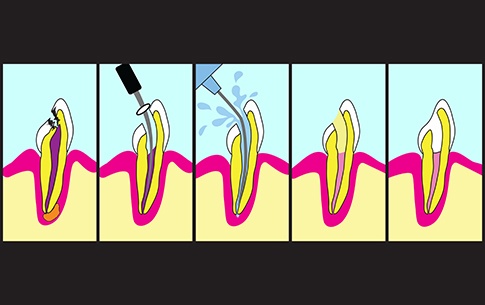 Animation of the steps in the root canal process