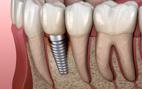 Illustration of a failed dental implant in Conway, SC
