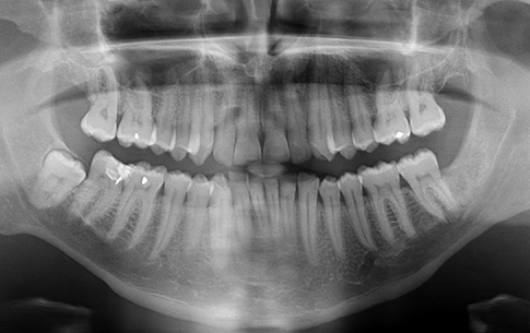 Panoramic x-rays of patient's smile