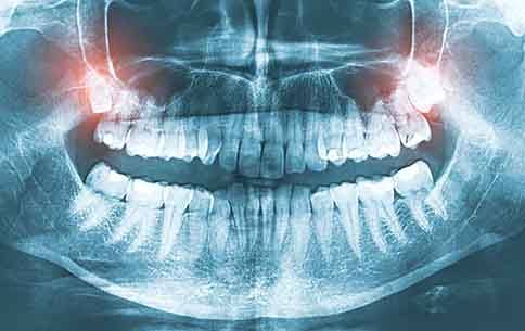 A dental x-ray highlighting a patient’s wisdom teeth