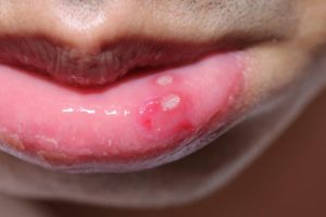 person with a canker sore on their lip