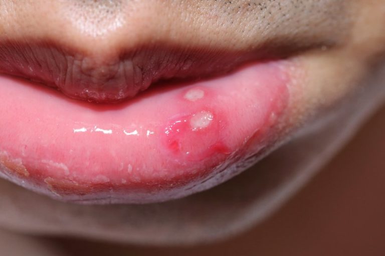 What Causes Canker Sores and Fever Blisters? American Dental Care