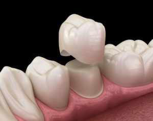 dental crown 3D illustration 