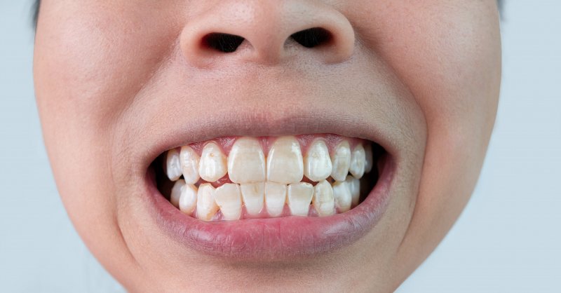 Close up of patient with white spots on teeth