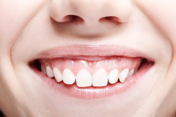closeup of gummy smile
