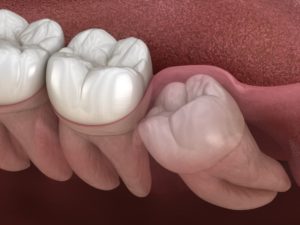 an x-ray of an older person’s wisdom teeth that need to be removed