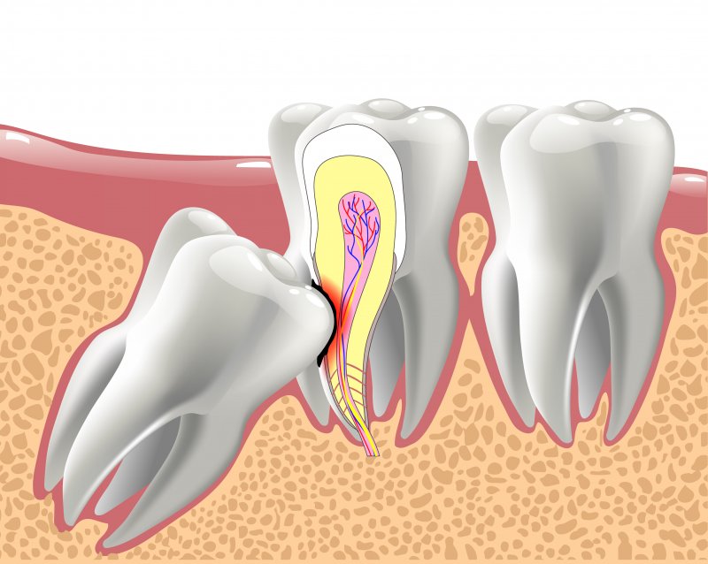 An illustration of an impacted wisdom tooth