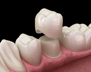 Illustration of a dental crown and a prepared tooth