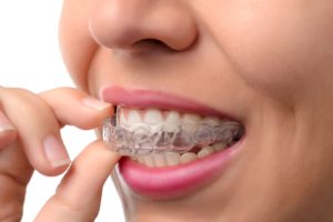 Closeup of a woman's mouth as she removes her Invisalign