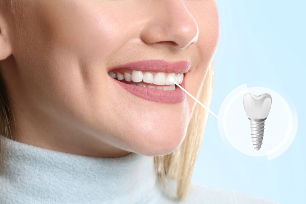 Woman with blond hair smiling with one tooth indicated as an implant