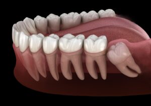Digital rendering showing impacted wisdom tooth.